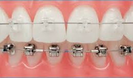 aparelho-dentario-ortodontia-estetica